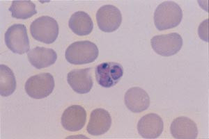 Figur 3   Tynn dr&aring;pe som viser erytrocytt infisert med tre trofozoitter. Slik trippelinfeksjon sees meget sjelden ved andre&hellip;