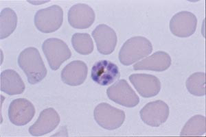 Figur 4   Schizont (eller preschizont) av P falciparum. Ved falciparummalaria ser man sjelden schizonter i perifert blod, og&hellip;