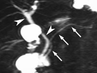 Figur 1   b) Samme pasient som i figur 1a), bilde tatt mens pasienten hadde abdominalsmerter under sekretinstimulering,&hellip;