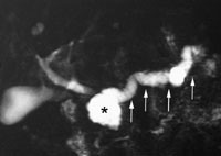 Figur 2   Utvidet pancreasgang, med kalibervekslinger, typiske for kronisk pankreatitt (piler). I tillegg sees i&hellip;