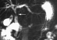 Figur 3   Stenose i gallegangen (pil), n&aelig;r innmunningen av ductus cysticus, senere p&aring;vist &aring; v&aelig;re et kolangiokarsinom