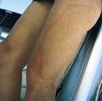 Utslett p&aring; l&aring;ret. Begge foto privat