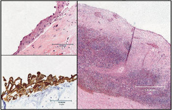 Figur 3   Histologisk bilde av miltcystevegg med fibrose og innvendig epitelialbekledning (pasient 2)