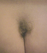 Figur 2   H&aring;rflekker som ofte sees ved diastematomyeli.