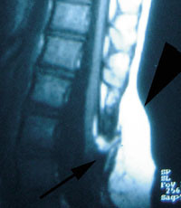 Figur 3   Lumbosakral MR av et subkutant lipom (pilhode) i kontakt med ryggmargen via defekter i lumbosakralfascien og bakre&hellip;