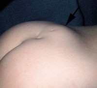 Figur 4   Lumbosakralt subkutant lipom