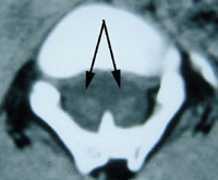 Figur 6   CT ved diastematomyeli hvor ryggmargen er spaltet i sagittalplanet, slik at man p&aring; ett eller flere niv&aring;er har to&hellip;