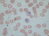 Figur 2   Pasient 1. To am&oslash;boide plasmodium vivax-trofozoitter ved innleggelse p&aring; grunn av residiv