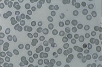 Figur 4   Pasient 2. Reduksjon av parasittemien til ca. 1 % etter utskiftingstransfusjon