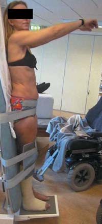 Figur 2   Ved kontroll etter siste operasjon kunne hun st&aring; i st&aring;rullestol og ha kontroll med bevegelse i armene. Publiseres&hellip;