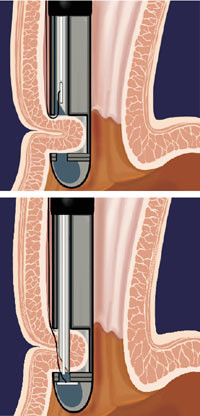 Figur 3   Prosedyre for endosutur: Med tilbaketrukket n&aring;l suges en slimhinnefold inn i suturkapselen p&aring; enden av&hellip;