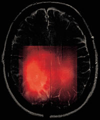 Figur&thinsp;&thinsp;4 Kjemisk skift-bildedanning (CSI) i en pasient med et astrocytom (grad 2), visualisert med r&oslash;d farge p&aring; et standard&hellip;