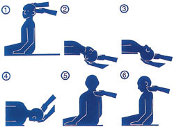 Figur&thinsp;&thinsp;4  Behandlingsman&oslash;ver modifisert etter Epley (14)