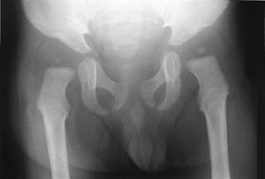 Figur&thinsp;&thinsp;4 R&oslash;ntgen av bekken viser dysplatiske hofter bilateralt