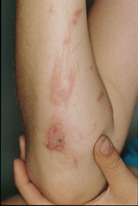 Figur&thinsp;&thinsp;2  Dermatitis bullosa striata pratensis