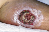 Figur&thinsp;&thinsp;3  Lesjon p&aring; leggen etter sannsynlig Loxosceles-bitt i Brasil. Pasienten hadde sittet med kortbukser p&aring; en&hellip;