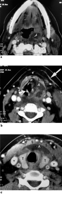 Figur&thinsp;&thinsp;3  Kontrastforsterket CT hals gjort dag 1. a) Snitt i tonsillniv&aring; viser abscedering submuk&oslash;st p&aring; venstre side, og med&hellip;