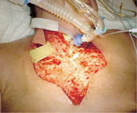 Figur&thinsp;&thinsp;4  Dag 19. Bildet viser hudreseksjonens omfatning foran p&aring; brystet. Et dren er lagt inn under gjenv&aelig;rende m&hellip;