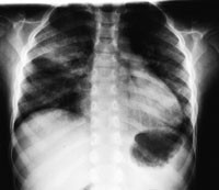 Figur 2  Bilde ni timer etter ekstubasjon viser oppklaring apikalt i begge overlapper, men med best&aring;ende svake diffuse&hellip;