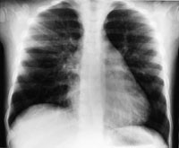 Figur 3  Bilde 48 timer etter ekstubasjon viser en normalisering av venstre lunge, men med bibeholdt volumreduksjon av h&oslash;yre&hellip;