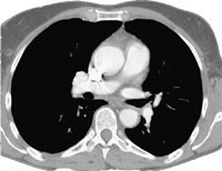 Figur 2  Pasient 1. Spiral-CT etter lokal invasiv behanling. Trombene kan ikkje lenger p&aring;visast