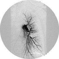 Figur 3  Pasient 3. Selektiv pulmonal angiografi med kateteret i venstre a. pulmonalis. Kontrastdefekt viser embolus i&hellip;