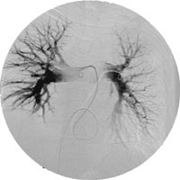 Figur 4  Pasient 3. Selektiv pulmonal angiografi neste dag. God framstilling av h&oslash;gre og venstre a. pulmonalis. Resttrombe i&hellip;