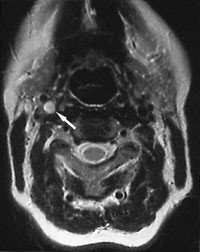 Figur 2  MR av pasient 3 viser okklusjon av h&oslash;yre carotis interna. H&oslash;ysignalet i karlumen (forenlig med trombe) var synlig&hellip;