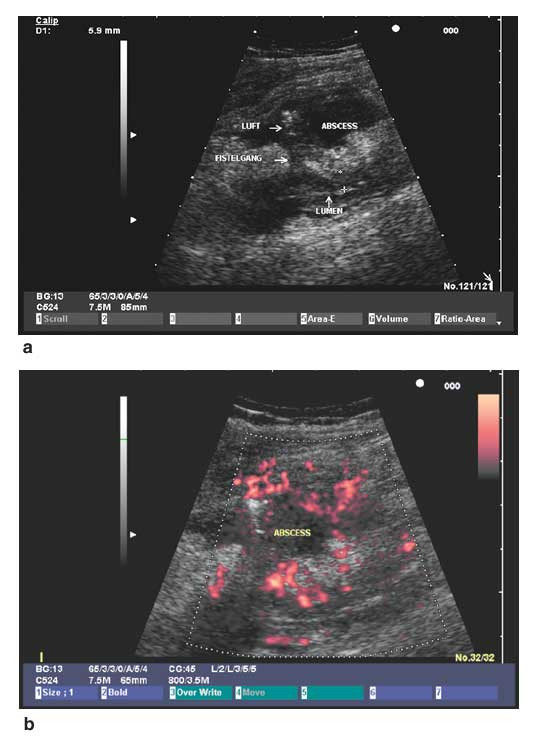 Figur 2  Pasient med terminal ileitt. a) Terminale ileum (todimensjonal ultrasonografi) viser homogen hypoekkoisk fortykket&hellip;