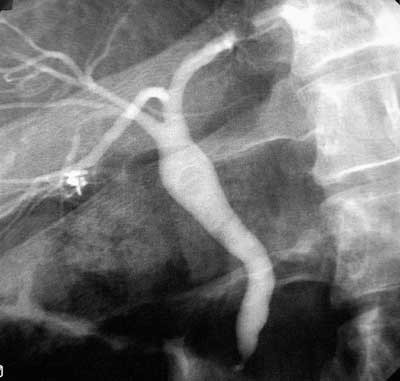 Figur 2 ERC utf&oslash;rt vel tre m&aring;neder etter operasjonen viser slanke intra- og ekstrahepatiske galleganger med luftbobler&hellip;
