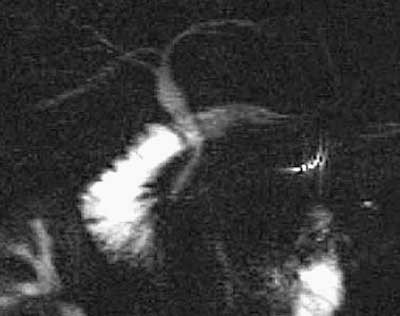 Figur 3 MRCP utf&oslash;rt fem &aring;r etter laparoskopisk inngrep viser fortsatt slanke galleganger uten mistanke om stein