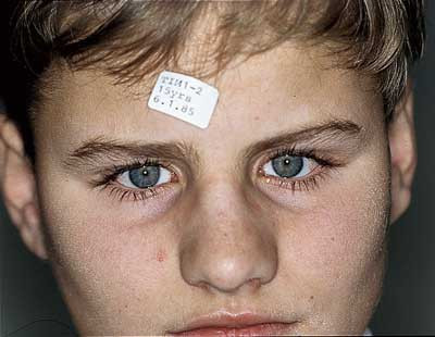 Figur 2   Illustrasjon av de sm&aring; pupiller. Foto T. Gedde-Dahl jr., Rettsmedisinsk Institutt, Rikshospitalet. Publisert med&hellip;