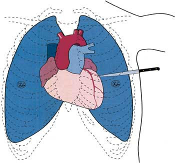 Den antatte plassering av stikkskaden som foranlediget verdens f&oslash;rste hjerteoperasjon. Innstikket var i fjerde&hellip;