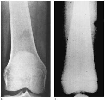 Figur 2 R&oslash;ntgenologisk bilde av distale del av a) et normalt l&aring;rbein og b) et med s&aring;kalt erlenmeyerkolbedeformitet