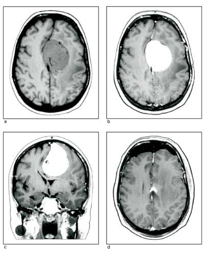 Figur 2 38 &aring;r gammel kvinne med tiltakende asteni og styringssvikt i h&oslash;yre underekstremitet. a) Preoperativ MR, aksial T1&hellip;