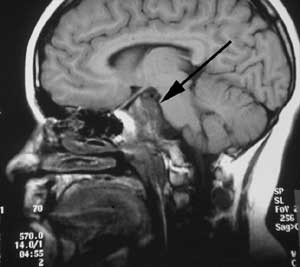 Figur 2 a) Preoperativ sagittal MR-unders&oslash;kelse med kontrast av kordom i clivus (pil)