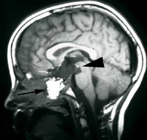 Figur 3 b) Postoperativ sagittal MR-unders&oslash;kelse med kontrast av kraniofaryngeom. Svulsten er borte (pilhode) og det er lagt&hellip;