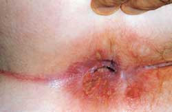 Figur 2  Perianale after hos pasient med idiopatisk n&oslash;ytropeni