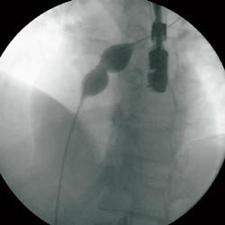 Figur 2 Ballongestimering av &aring;pentst&aring;ende foramen ovale