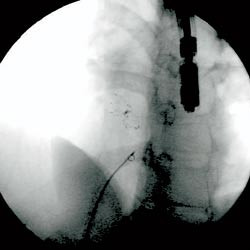 Figur 5 R&oslash;ntgenbilde av CardioSEAL i riktig posisjon p&aring; atrieseptum