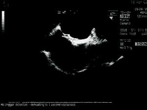 Figur 6 Trans&oslash;sofageal ekkokardiografi av CardioSEAL i riktig posisjon p&aring; atrieseptum