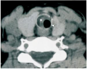 Figur 2 CT-snitt av &oslash;vre trachea hos pasient nr. 2 (snittykkelse 3 mm, vindusbredde 250). P&aring; innsiden av trakealringen sees&hellip;