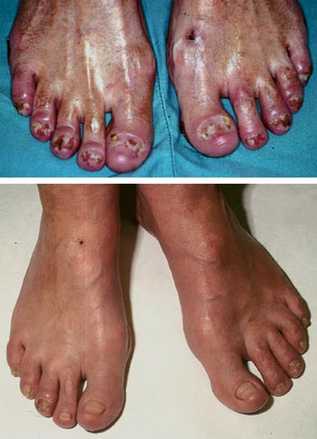 Figur 2 Pasient 3 med acrodermatitis continua suppurativa (Hallopeau) p&aring; f&oslash;ttene f&oslash;r behandling med infliximab og status f&oslash;r&hellip;