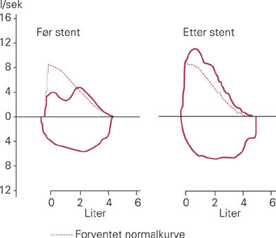 Samme pasient som i figur 1, spirometri (luftstr&oslash;msvolumkurve) f&oslash;r og etter stentnedleggelse. Legg merke til den flate og&hellip;