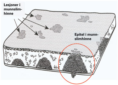 Figur 2  Multifokal klonal vekst: &laquo;feltkarsinogenese&raquo;. Eksponering for karsinogen (tobakk) skjer i hele slimhinnens&hellip;