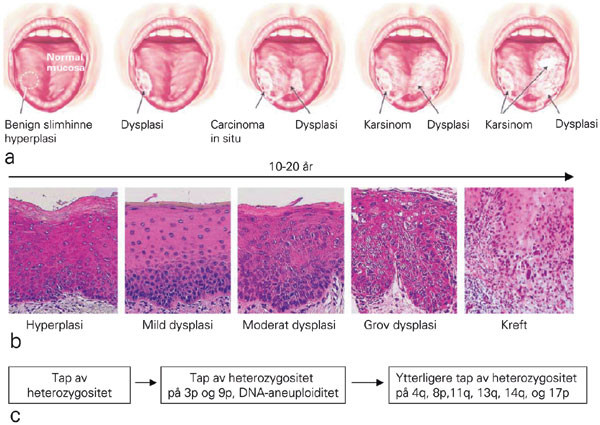 Figur 3  Klinisk, patologisk og molekyl&aelig;r utvikling av munnhulekreft. a) Klinisk utvikling av karsinom i munnhulen&hellip;