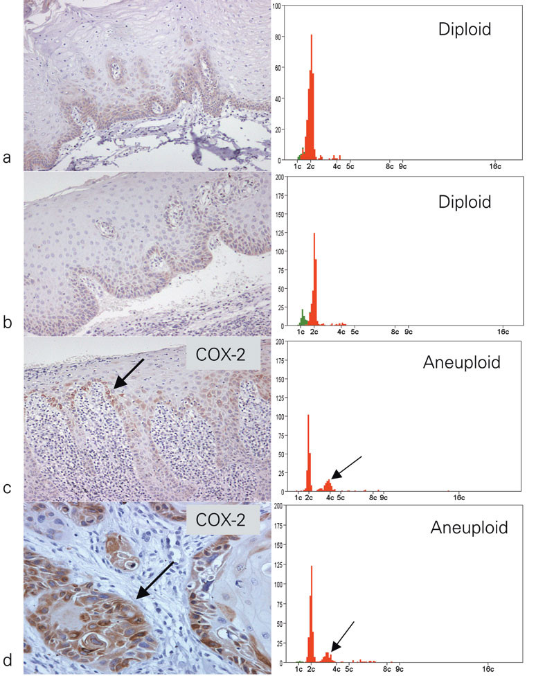 Figur 6  Oppregulering av COX-2 ved utvikling av kreft i munnhule. a) COX-2 er ikke oppregulert i normal munnslimhinne. b)&hellip;