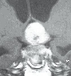 Figur 3  Stort hypofyseadenom hos mann, 52 &aring;r med &oslash;kende hukommelsestap, ust&oslash;het og d&aring;rlig syn. Tumor vokser inn i 3&hellip;
