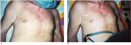 Figur 2  Kvinnekateter a) skj&oslash;vet inn i og b) trukket ut av abscess under brystveggen