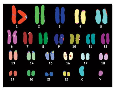 Figur 3  Ved M-FISH f&aring;r hvert kromosom en unik farge. Bildet viser normale kromosomer (med tillatelse fra Randi Hovland,&hellip;